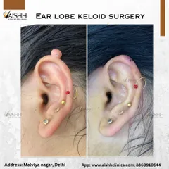 The final result of an earlobe keloid surgery. The procedure restores the natural shape of the earlobe, allowing the patient to wear earrings again without worry.