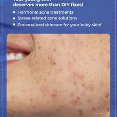 Your skin deserves a proper diagnosis, not just another DIY fix from the internet. I offer solutions for hormonal acne, stress-related breakouts, and personalized skincare to finally get your skin clear.