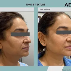 This patient's results after 30 days of AdvaTx treatment show a marked improvement in overall skin tone and texture. The skin appears smoother, firmer, and more radiant.