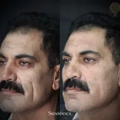 As we age, we can lose volume in key areas of the face. This image shows how fillers can be used to counteract age-related atrophy, restoring structure and fullness for a more youthful and rested look.