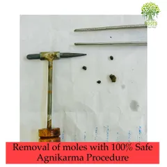 This image displays the Agnikarma tool alongside the moles that were safely and effectively removed during the procedure.