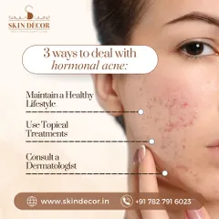 Dealing with hormonal acne requires a multi-faceted approach. Maintaining a healthy lifestyle, using the right topical treatments, and consulting a dermatologist to get a personalized plan are the three key steps to getting it under control.