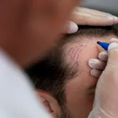 Precision is the foundation of a successful hair transplant. Here, I am carefully marking the new hairline for a client before a Follicular Unit Extraction (FUE) procedure. This planning stage is crucial to ensure the final result looks completely natural and complements your features.