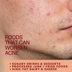 Foods that can worsen acne for some people include sugary drinks, processed junk food, and high-fat dairy. It's not the same for everyone, but being mindful of these can help manage breakouts.