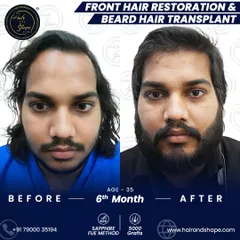 This patient wanted to address both his receding hairline and patchy beard. This 6-month result after a 5000-graft Sapphire FUE procedure shows a complete transformation.