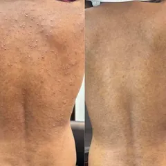 Clearing Painful Back Boils. This before-and-after demonstrates the successful treatment of severe back boils (folliculitis). My approach addresses the root bacterial cause and restores smooth, healthy skin.