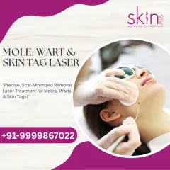This image shows a laser treatment in progress for removing a skin growth. It emphasizes the precise, scar-minimized removal I offer for moles, warts, and skin tags.