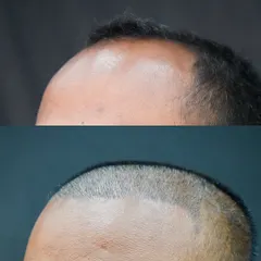This before-and-after image shows the result just 10 days after a 4300-graft FUE procedure. You can see the newly designed, denser hairline that will frame the face and create a more youthful appearance.