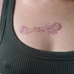 This is a hypertrophic scar, which is a thick, raised scar that forms after an injury. I treat these with methods like intralesional injections or laser therapy to break down the excess collagen, flatten the scar, and improve its appearance.