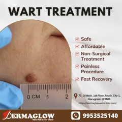 Your safety and comfort are our priority. Our wart removal treatment is a non-surgical and virtually painless procedure that ensures a fast recovery, allowing you to return to your daily life with confidence.