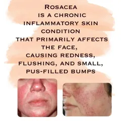 Rosacea is a chronic inflammatory condition that causes facial redness and bumps. Understanding what it is is the first step toward managing it.