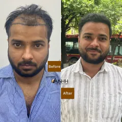 Just 6 months after his procedure for Grade 4 baldness, this patient is enjoying a full head of hair. We used the FUE-DHT technique to ensure maximum graft survival and a dense, natural outcome.