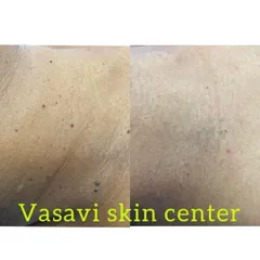 This image displays the successful clearance of multiple small skin tags from the neck and upper chest area. Even when numerous, each tag is treated individually to ensure a comprehensive and blemish-free outcome.