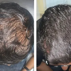 This image shows the significant improvement in hair density and scalp coverage for a patient after completing a customized hair regrowth plan. The goal of my treatment is not just to stop hair fall but to achieve tangible new growth, resulting in fuller and healthier hair.