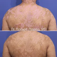 The patient's back shows a near-complete reduction in scaling and redness. This is what effective, evidence-based treatment looks like. It's not just about clearing the skin, but about giving patients their lives back.