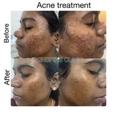Here is another example of progress in treating both active acne and the pigmentation it leaves behind. By combining in-clinic procedures with a proper at-home regimen, we can achieve a more even and healthy complexion.