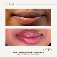 See the transformation with my permanent lip blush service. I corrected the dark pigmentation and gave her lips a beautiful, natural pink tint. This is perfect for anyone tired of reapplying lipstick and wanting an effortlessly defined look.