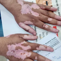 The hands and fingertips are common but challenging areas for Vitiligo treatment because the skin is different. I use a combination of therapies and sometimes surgery for these spots.