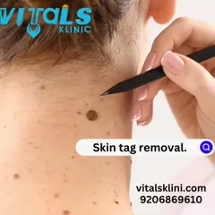 This image highlights our skin tag removal service. Skin tags are common and benign, and I remove them quickly and painlessly using methods like electrocautery for immediate results.