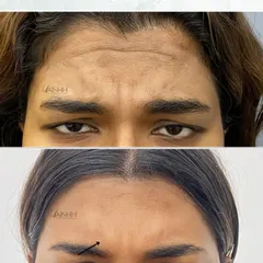 Here we have treated the "angry 11s" or frown lines between the eyebrows. Softening these lines makes the entire face look more rested and approachable.