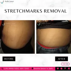 This image shows a significant reduction in the appearance of abdominal stretch marks after treatment. My approach helps to rebuild collagen and elastin, making the marks less visible and improving the skin's texture.