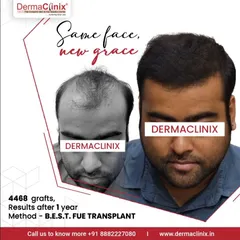 A one-year result after a 4,468 graft B.E.S.T. FUE transplant. This transformation demonstrates how we can achieve full coverage and a natural appearance, giving the same face a completely new grace.