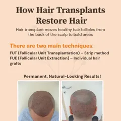 How do hair transplants restore hair? The procedure involves moving healthy, DHT-resistant hair follicles from the back of the scalp to the balding areas. This provides a permanent, natural-looking solution.