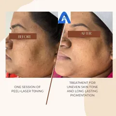 Another angle showing the improvement in facial pigmentation after a single session of a peel and laser toning. This combination helps break down pigment and exfoliate the skin for faster results.