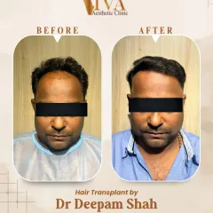 Here is the frontal view of the same patient. The key to a great hair transplant is ensuring the density looks full and the hairline doesn't appear as a harsh, straight line.