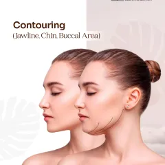 Achieving a defined jawline or reducing buccal fat can be done without surgery. I use Ignite RF to deliver precise thermal energy that sculpts facial contours, tightens skin, and refines the jawline, chin, and cheek areas for a more defined appearance.