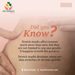 Did you know that stretch marks can affect both men and women? This informational post debunks common myths and explains that these marks develop when our skin stretches or shrinks quickly. We offer treatments to reduce their appearance.