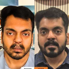 Here you can see a direct before and after comparison for the same patient. We successfully filled in the patchy areas on his lower beard and created a full, natural-looking moustache over the difficult scar tissue on his upper lip using a targeted FUE transplant.