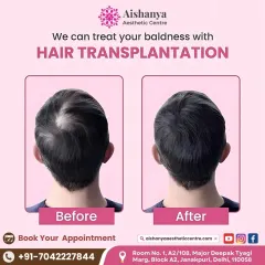 For advanced hair loss, a hair transplant can be a life-changing solution. Here is a clear example of how I create a natural, dense hairline, permanently restoring hair to a previously bald area.