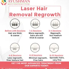 We believe in setting clear expectations for your laser hair removal journey. This guide shows the typical progression from thick hair to finer, sporadic regrowth over 8 to 10 sessions, leading to long-lasting smooth skin.