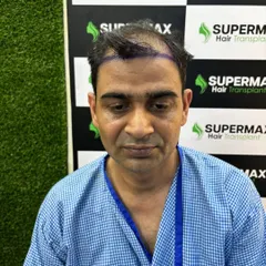 A frontal view of the client before the procedure, with the new hairline drawn to frame the face perfectly.