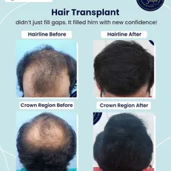 This transformation is about more than just filling gaps in the hairline and crown region. It's about rebuilding confidence from the roots up, strand by strand.