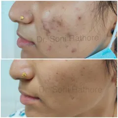 This before and after photo shows the successful completion of step one: treating active acne. You can see a dramatic reduction in inflammation and breakouts. Now, we can begin to focus on the post-inflammatory marks.
