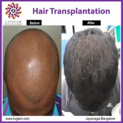 This before and after showcases a complete transformation for a client with advanced male pattern baldness. Our hair transplant surgery provided full coverage and a natural, dense result.