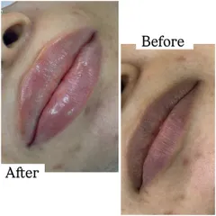 For anyone with pigmented lips, lip neutralization is a game changer. This before and after shows how I corrected the darker tones to create a healthy, even, and naturally pink pout.