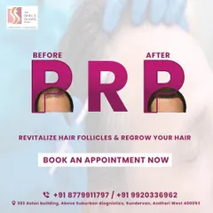 This before and after demonstrates the power of PRP therapy. By using the client's own growth factors, we revitalized the hair follicles, leading to a fuller hairline and denser hair. This is a non-surgical approach to effectively regrow your hair.