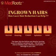 Many of my patients struggle with ingrown hairs from shaving or waxing. This diagram shows how laser treatment is the superior solution. By targeting the hair follicle root directly, the laser prevents the hair from growing back, which puts an end to the irritation, pain, and potential scarring caused by ingrowns.