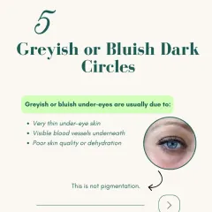 Greyish or bluish dark circles are usually not a sign of pigmentation. This is typically caused by very thin under-eye skin, which makes the blood vessels underneath more visible.