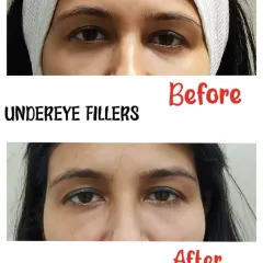 This before-and-after image clearly shows the results of our under-eye filler treatment. We effectively reduced the appearance of hollows and dark circles, resulting in a brighter, more rested, and rejuvenated look for our client.