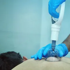 Cupping therapy is an ancient technique we use to decompress tissue and improve blood flow. Here, a therapist applies suction cups to a client's back to release muscle tension.