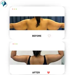 This is another view of an arm lift (brachioplasty) result. The before photo shows excess skin and fat on the back of the arms and upper back, which has been significantly reduced in the after photo for a smoother contour.