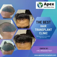 As one of the best hair transplant clinics in the region, we offer comfortable and comprehensive hair care. This graphic showcases the consistent, high-quality results we deliver to our clients.