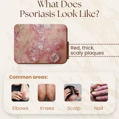 This visual guide shows what psoriasis typically looks like: red, thick, scaly plaques. It commonly appears on elbows, knees, the scalp, and even nails, and is often mistaken for dandruff or a fungal infection, making a correct diagnosis essential.