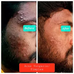 A closer look at the progress made in treating acne vulgaris. Reducing inflammation and preventing new lesions are the first steps toward clear skin and scar prevention.