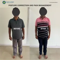 This before-and-after image showcases a real client's postural transformation. Through a targeted program combining physiotherapy and Pilates, we were able to realign his spine, reduce chronic pain, and improve his overall stability and function.