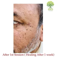 This photo was taken one week after the client's first Agnikarma session. You can see the moles are already healing and diminishing.